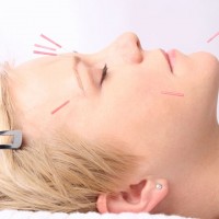 facial-treatment-with-acupuncture
